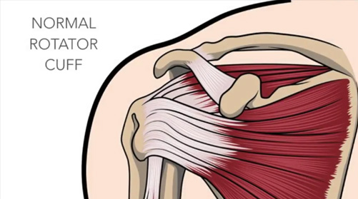 Rotator Cuff - Healthier Illinois